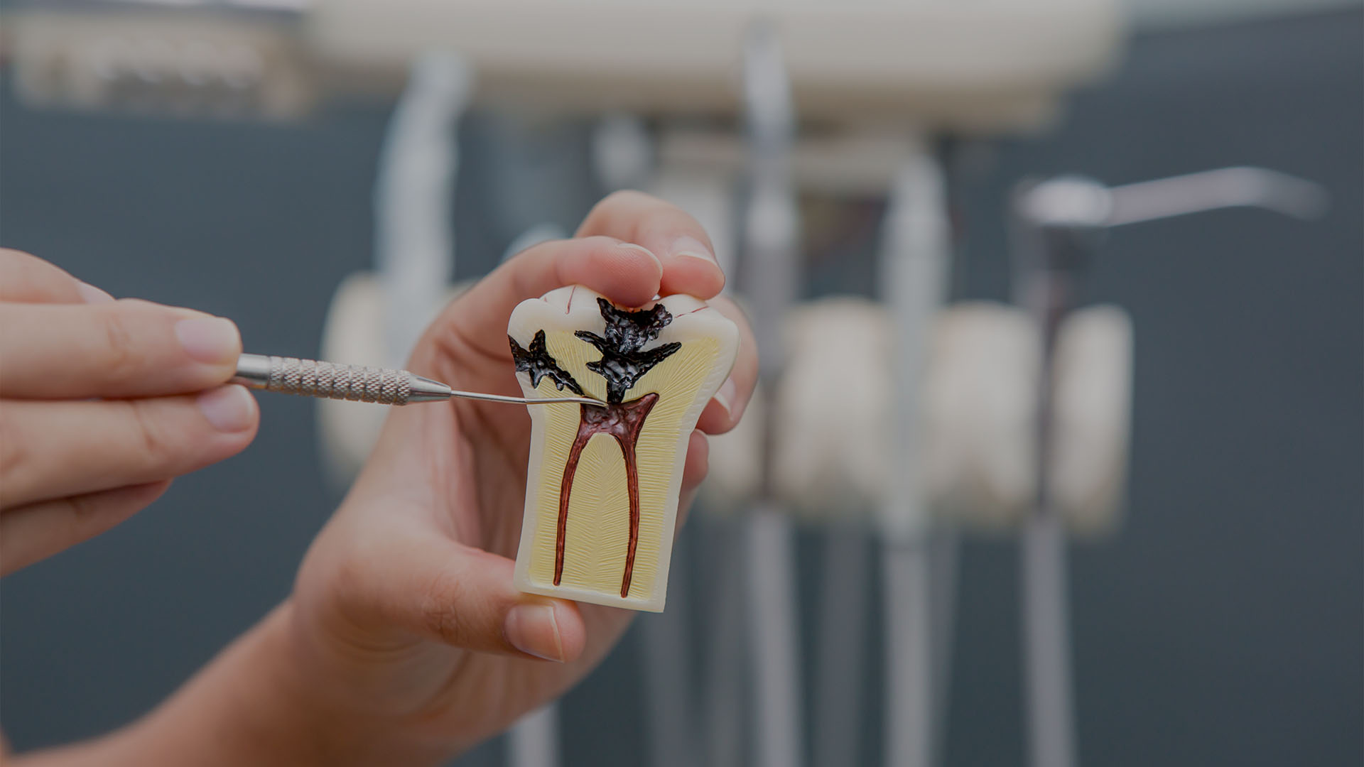 Cuidado dental después de una endodoncia